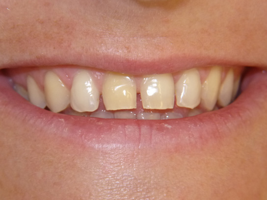 Ricostruzione dei denti: interventi conservativi e non invasivi (luglio  2021) - Antonella Udeschini - Estetica dentale: odontoiatria estetica e  cosmetica